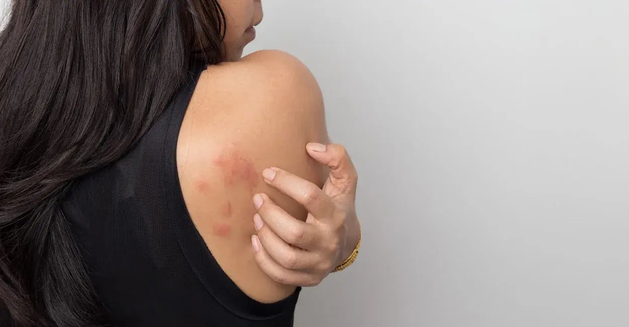 FI Rentokil bedbug bites